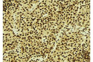ABIN6274846 at 1/100 staining Human breast cancer tissue by IHC-P. (CDKN2AIP anticorps  (Internal Region))