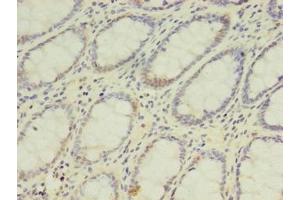 Immunohistochemistry of paraffin-embedded human colon cancer using ABIN7142126 at dilution of 1:100 (DPH2 anticorps  (AA 1-489))