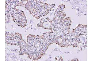 IHC-P Image Immunohistochemical analysis of paraffin-embedded human lung cancer, using FOXRED1, antibody at 1:300 dilution. (FOXRED1 anticorps)