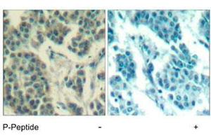Immunohistochemical analysis of paraffin-embedded human breast carcinoma tissue using ERBB3 (phospho Y1328) polyclonal antibody . (ERBB3 anticorps  (pTyr1328))
