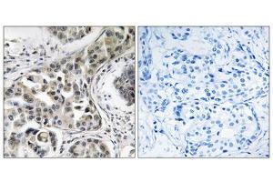 Immunohistochemistry analysis of paraffin-embedded human breast carcinoma tissue using USP6NL antibody. (USP6NL anticorps  (Internal Region))