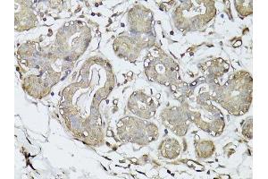 Immunohistochemistry of paraffin-embedded human breast cancer using GAPDH antibody. (GAPDH anticorps  (AA 1-335))