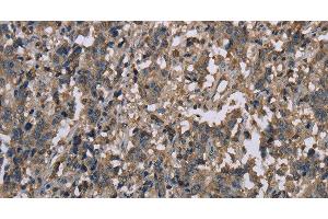 Immunohistochemistry of paraffin-embedded Human liver cancer tissue using MCC Polyclonal Antibody at dilution 1:30 (MCC anticorps)