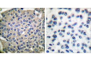 P-peptide - +Immunohistochemical analysis of paraffin-embedded human breast carcinoma tissue using Cortactin (phospho-Tyr466) antibody. (Cortactin anticorps  (pTyr466))
