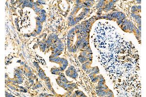 ABIN6264114 and ABIN6273293 at 1/100 staining Human colorectal cancer by IHC-P.