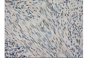 Immunohistochemical staining of paraffin-embedded Carcinoma of kidney tissue using anti-SLC18A2 mouse monoclonal antibody. (SLC18A2 anticorps)