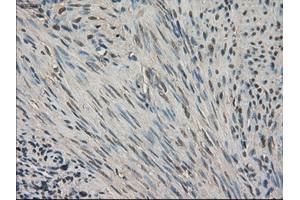 Immunohistochemical staining of paraffin-embedded Carcinoma of kidney tissue using anti-SLC18A2 mouse monoclonal antibody.