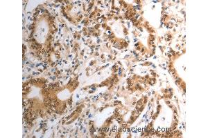 Immunohistochemistry of Human gastric cancer using RAD50 Polyclonal Antibody at dilution of 1:40 (RAD50 anticorps)