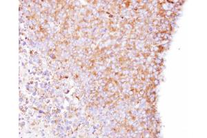 IHC-P Image Immunohistochemical analysis of paraffin-embedded H1299 xenograft , using Coronin-1B, antibody at 1:500 dilution.