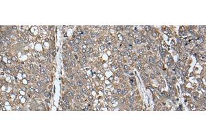 Immunohistochemistry of paraffin-embedded Human liver cancer tissue using ATAD1 Polyclonal Antibody at dilution of 1:65(x200) (ATAD1 anticorps)