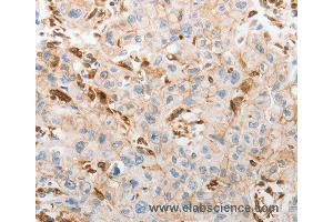 Immunohistochemistry of Human lung cancer using SLC15A2 Polyclonal Antibody at dilution of 1:60
