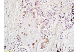 Formalin-fixed and paraffin embedded human lung carcinoma labeled with Rabbit Anti ARHGAP24 Polyclonal Antibody, Unconjugated  at 1:200 followed by conjugation to the secondary antibody and DAB staining (ARHGAP24 anticorps  (AA 501-600))