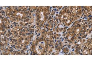 Immunohistochemistry of paraffin-embedded Human thyroid cancer using GALK1 Polyclonal Antibody at dilution of 1:40