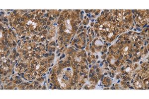 Immunohistochemistry of paraffin-embedded Human thyroid cancer using GALK1 Polyclonal Antibody at dilution of 1:40 (GALK1 anticorps)