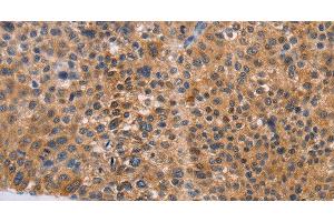 Immunohistochemistry of paraffin-embedded Human liver cancer tissue using NIF3L1 Polyclonal Antibody at dilution 1:30 (NIF3L1 anticorps)