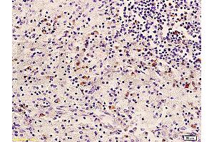 Formalin-fixed and paraffin embedded human cervical carcinoma labeled with Anti-HER2/NEU/ErbB2 Polyclonal Antibody, Unconjugated (ABIN725345) at 1:400 followed by conjugation to the secondary antibody and DAB staining (ErbB2/Her2 anticorps  (AA 1210-1255))