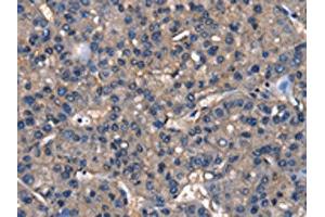 The image on the left is immunohistochemistry of paraffin-embedded Human liver cancer tissue using ABIN7129820(IGFBP5 Antibody) at dilution 1/25, on the right is treated with fusion protein. (IGFBP5 anticorps)