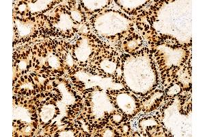ABIN7094292 and ABIN7098339 at 1/100 staining Human lung cancer by IHC-P. (HTATSF1 anticorps  (C-Term))