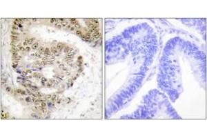 Immunohistochemistry analysis of paraffin-embedded human colon carcinoma tissue, using hnRNP L Antibody. (HNRNPL anticorps  (AA 61-110))