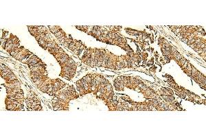 Immunohistochemistry of paraffin-embedded Human colorectal cancer tissue using ATP5PD Polyclonal Antibody at dilution of 1:50(x200) (ATP5H anticorps)