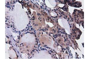 Immunohistochemical staining of paraffin-embedded Adenocarcinoma of Human ovary tissue using anti-CBWD1 mouse monoclonal antibody. (CBWD1 anticorps)