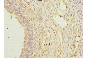 Immunohistochemistry of paraffin-embedded human ovarian cancer using ABIN7171670 at dilution of 1:100 (TCTEX1D2 anticorps  (AA 1-142))