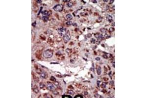 Formalin-fixed and paraffin-embedded human cancer tissue reacted with the primary antibody, which was peroxidase-conjugated to the secondary antibody, followed by AEC staining. (DGKA anticorps  (C-Term))