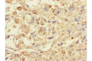 Immunohistochemistry of paraffin-embedded human melanoma using ABIN7146024 at dilution of 1:100
