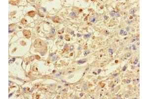Immunohistochemistry of paraffin-embedded human melanoma using ABIN7146024 at dilution of 1:100 (SPAG9 anticorps  (N-Term))