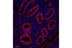 Immunofluorescence analysis of paraffin embedded human endometrial cancer using GDF5 (ABIN7074131) at dilution of 1: 200