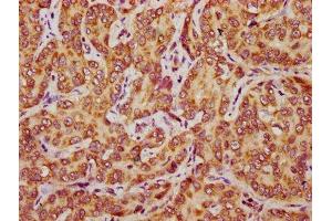 IHC image of ABIN7149130 diluted at 1:500 and staining in paraffin-embedded human liver cancer performed on a Leica BondTM system. (CCDC56 anticorps  (AA 2-57))