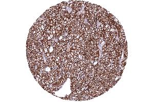 Kidney Chromophobe renal cell carcinoma with strong CDH16 immunostaining of tumor cells CDH16 immunohistochemistry (Recombinant Cadherin-16 anticorps)