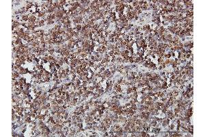 Immunoperoxidase of monoclonal antibody to SLC44A2 on formalin-fixed paraffin-embedded human lymphoma.