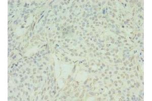 Immunohistochemistry of paraffin-embedded human breast cancer using ABIN7170902 at dilution of 1:100