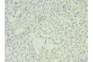 Immunohistochemistry of paraffin-embedded human breast cancer using ABIN7170902 at dilution of 1:100 (SDHC anticorps  (AA 30-62))