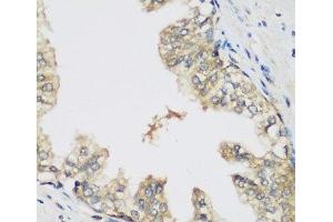 Immunohistochemistry of paraffin-embedded Human prostate using RRM1 Polyclonal Antibody at dilution of 1:200 (40x lens). (RRM1 anticorps)