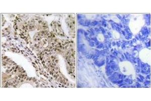 Immunohistochemistry analysis of paraffin-embedded human lung carcinoma, using AS160 (Phospho-Thr642) Antibody. (TBC1D4 anticorps  (pThr642))