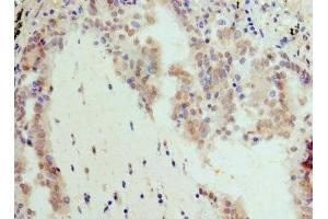 Immunohistochemistry of paraffin-embedded human lung cancer using ABIN7145816 at dilution of 1:100 (BRD7 anticorps  (AA 601-651))