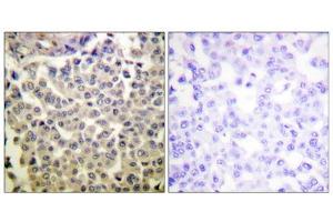 Immunohistochemistry analysis of paraffin-embedded human breast carcinoma tissue using PAK1/2/3 (Phospho-Thr423/402/421) antibody. (PAK1/2/3 anticorps  (pThr402, pThr421, pThr423))