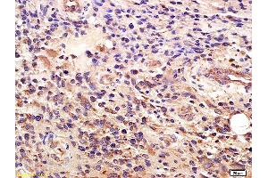 Formalin-fixed and paraffin embedded human glioma labeled with Anti-GLI1/ZFP5 Polyclonal Antibody, Unconjugated (ABIN673374) at 1:200 followed by conjugation to the secondary antibody and DAB staining. (GLI1 anticorps  (AA 601-700))