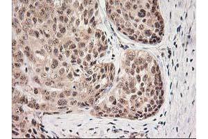 Immunohistochemical staining of paraffin-embedded Adenocarcinoma of Human breast tissue using anti-MGLL mouse monoclonal antibody. (MGLL anticorps)