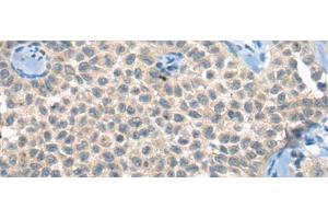 Immunohistochemistry of paraffin-embedded Human ovarian cancer tissue using CLTCL1 Polyclonal Antibody at dilution of 1:60(x200) (CLTCL1 anticorps)