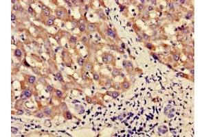 Immunohistochemistry of paraffin-embedded human liver cancer using ABIN7162571 at dilution of 1:100