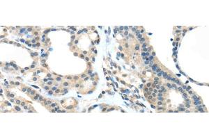 Immunohistochemistry of paraffin-embedded Human thyroid cancer tissue using VSIG10 Polyclonal Antibody at dilution 1:45 (VSIG10 anticorps)