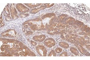 IHC-P Image Immunohistochemical analysis of paraffin-embedded human gastric cancer, using TRIM23, antibody at 1:100 dilution. (TRIM23 anticorps  (N-Term))
