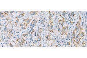Immunohistochemistry of paraffin-embedded Human liver cancer tissue using PLA2G15 Polyclonal Antibody at dilution of 1:65(x200) (PLA2G15 anticorps)