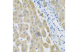 Immunohistochemistry of paraffin-embedded human liver cancer using ALG2 Antibody.