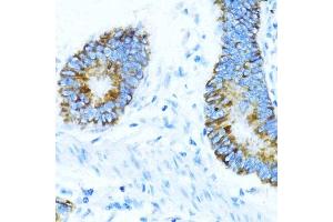 Immunohistochemistry of paraffin-embedded human colon carcinoma using NOX1 antibody (ABIN7268824) at dilution of 1:100 (40x lens).