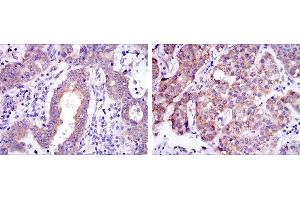 Immunohistochemical analysis of paraffin-embedded endometrial cancer tissues (left) and liver cancer tissues (right) using c-Rel mouse mAb with DAB staining.