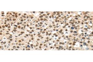 Immunohistochemistry of paraffin-embedded Human breast cancer using UBA1 Polyclonal Antibody at dilution of 1/40 (UBA1 anticorps)